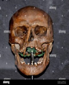 Mighty Vikings battled severe diseases, reveals 10th-century skulls’ study