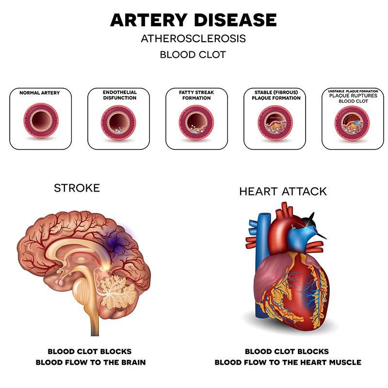 Scientists make disturbing discovery after analyzing stroke patients’ arteries: ‘We did not know that’