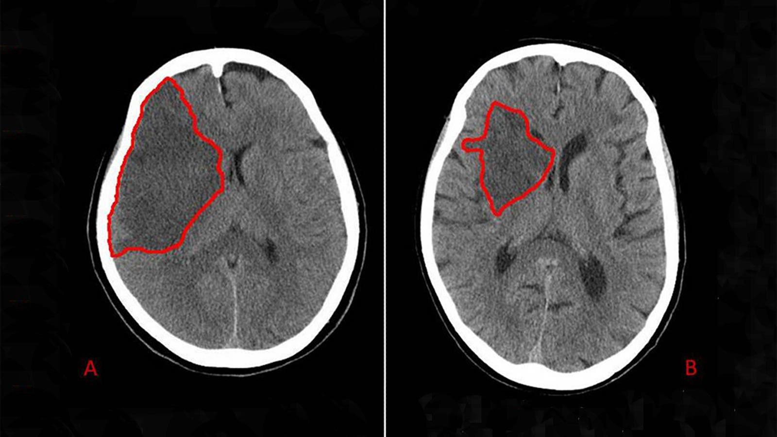 Scientists make disturbing discovery after analyzing stroke patients' arteries: 'We did not know that'
