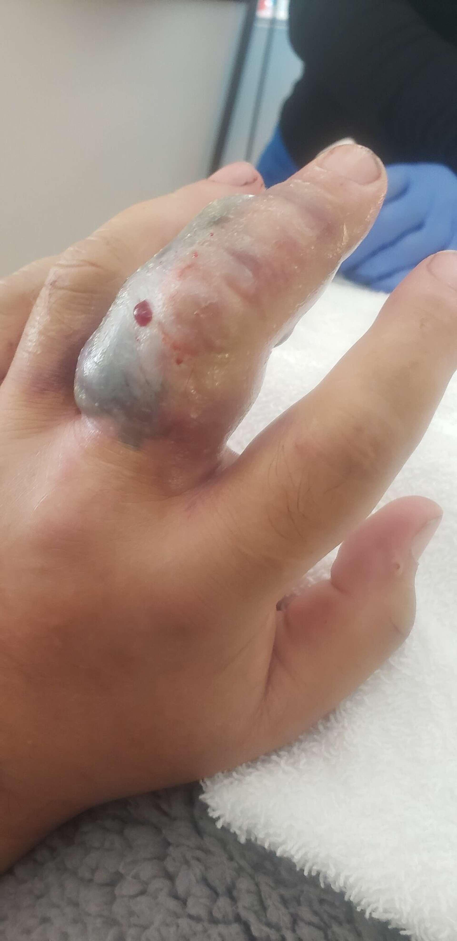 Teen Felt a Prick, Then Spotted Rattlesnake. When He Rolled Down His Sock, He Saw 'Two Red Dots and Blood'