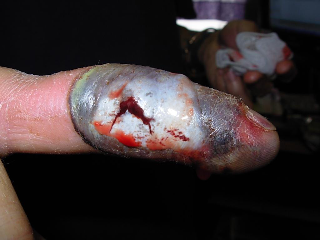 Teen Felt a Prick, Then Spotted Rattlesnake. When He Rolled Down His Sock, He Saw ‘Two Red Dots and Blood’